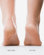 SoleSmooth | Electric Callus Remover for Salon-Soft Feet